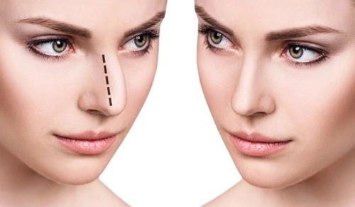 جراحی زیبایی بینی (رینوپلاستی) و جدید ترین روش ها