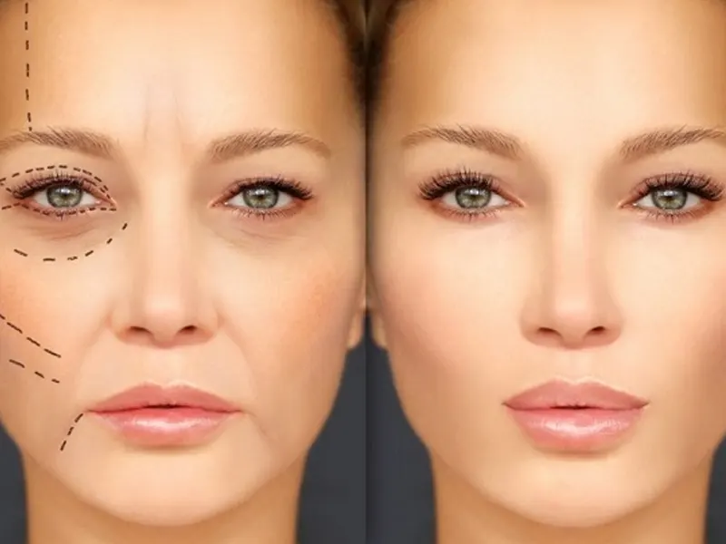 لیفت صورت در کلینیک زیبایی روژا