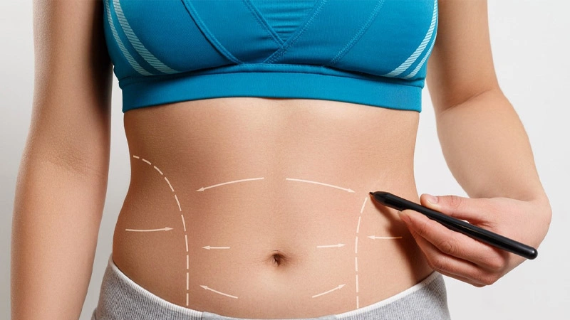 جراحی زیبایی شکم | آبدومینوپلاستی