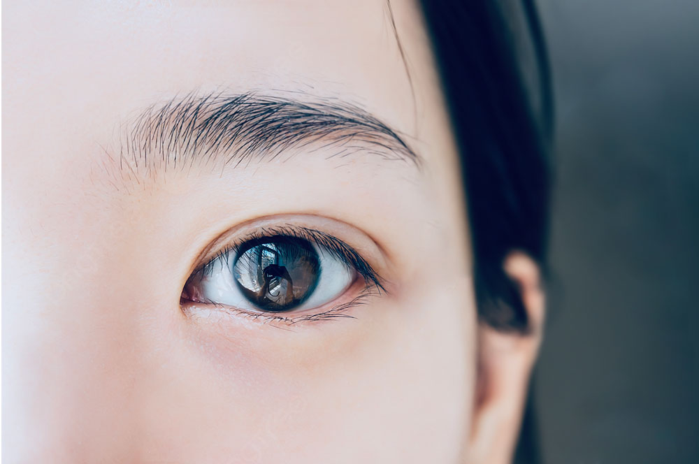 جراحی پلک آسیایی (بلفاروپلاستی آسیایی)