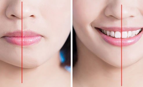 جراحی و پروتز چانه (ژنیوپلاستی)