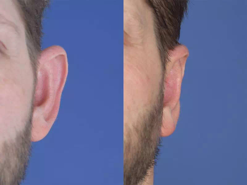 جراحی گوش (اتوپلاستی)