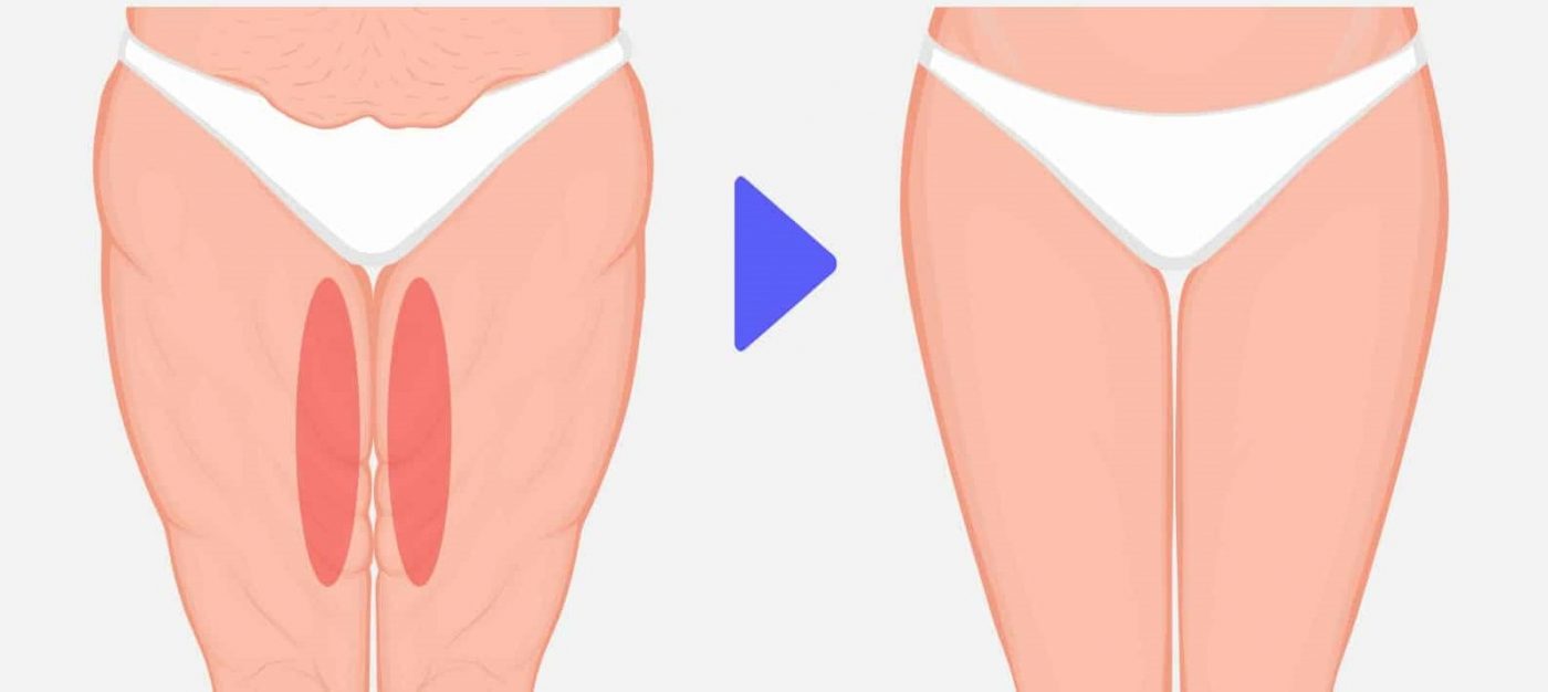 لیفت ران (تای‌پلاستی)