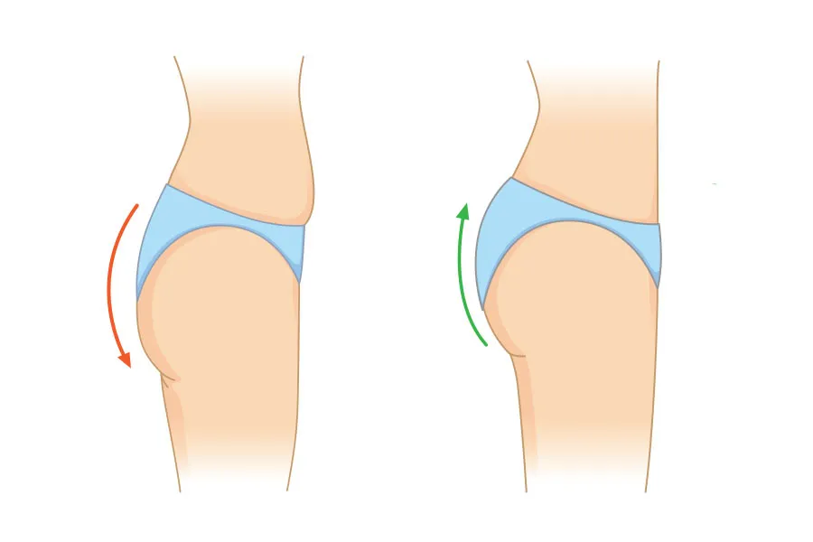 فرم دهی باسن یا لیپوترانسفر